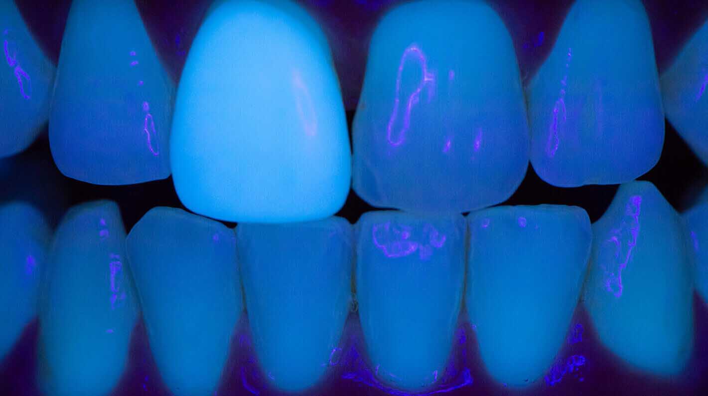 Facette en composite dentaire sous lumière ultraviolette où l'on peut observer sa fluorescence
