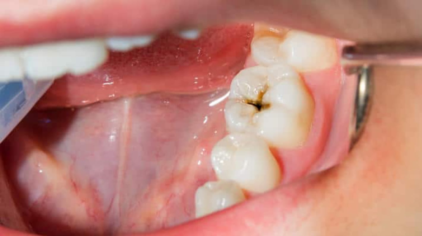 How to easily detect the limits of Dental Caries