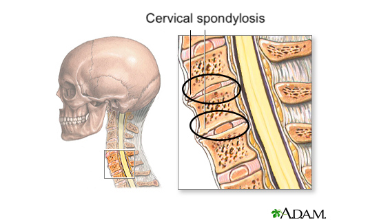 Cervical spondylosis