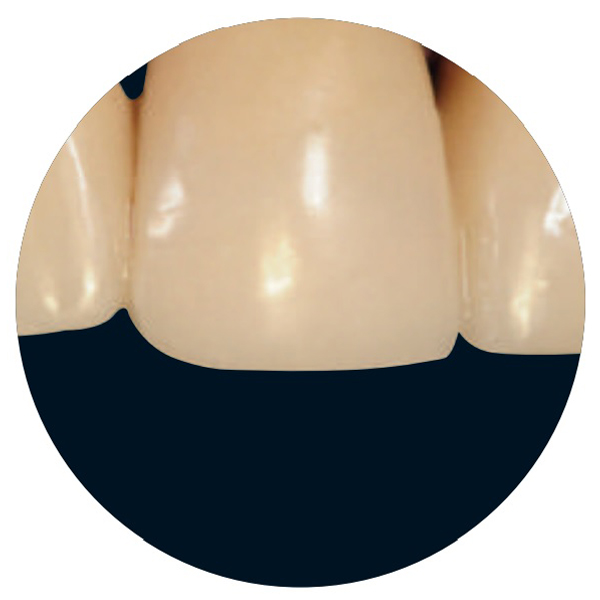 Clinical case study 4: Intraoral repair of a metal-ceramic bridge