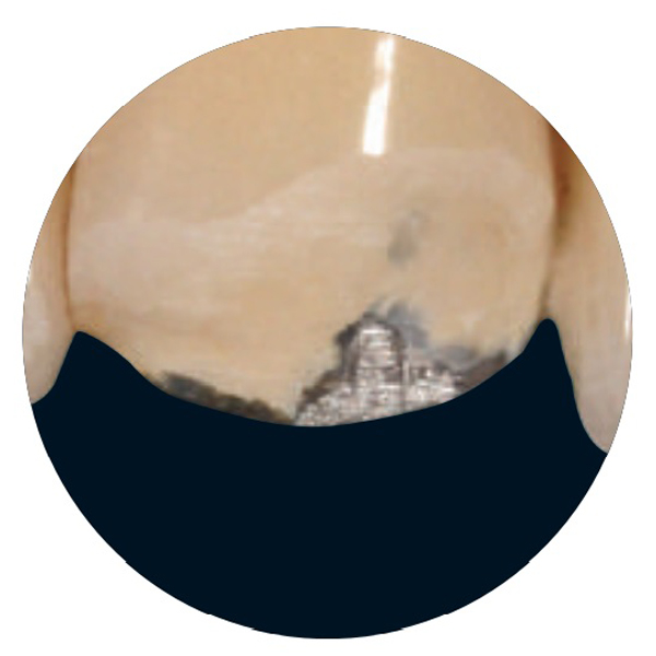 Case report 4: Intraoral repair of a metal-ceramic bridge