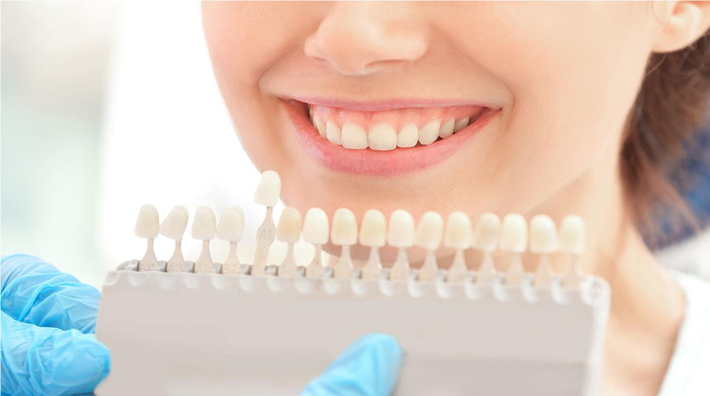 How to choose dental composite colour