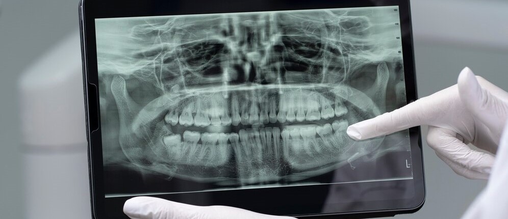 Dental X-rays