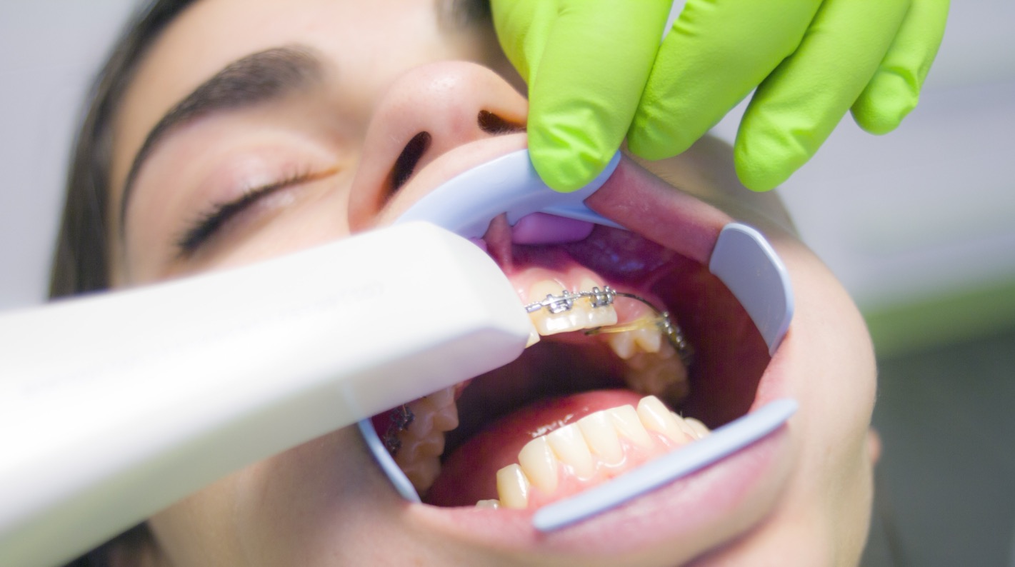 Digital dental impression eliminates traditional impression mistakes