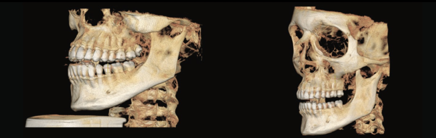 Image comparison: CBCT FOV 16 x 10 versus FOV 15 x 15