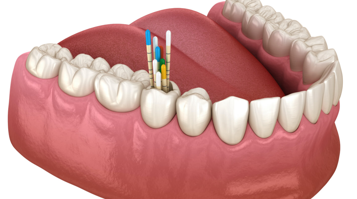 The Complete Guide to Dental Gutta-Percha: It's use in Endodontics - Dental Supplies and Equipment - Dentaltix