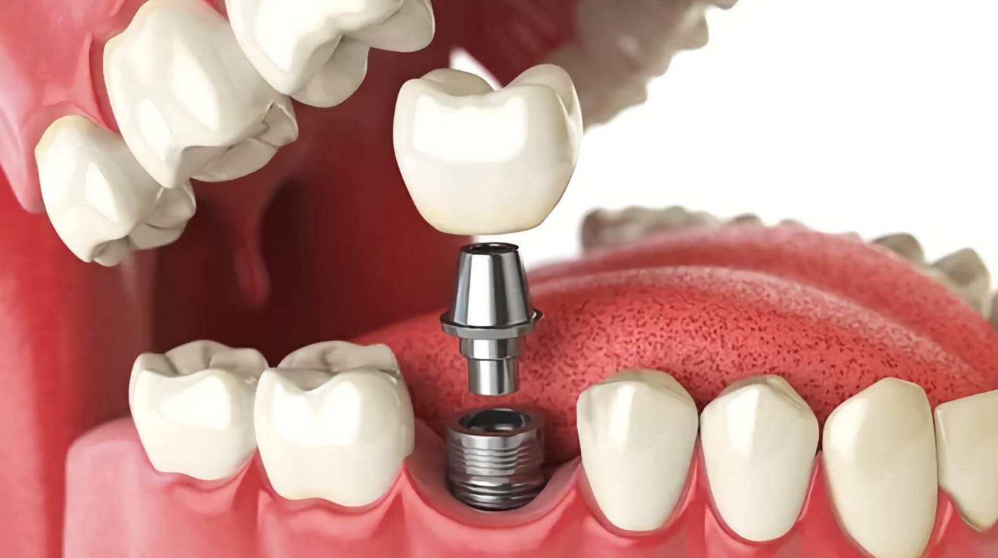 Special care for dental implants