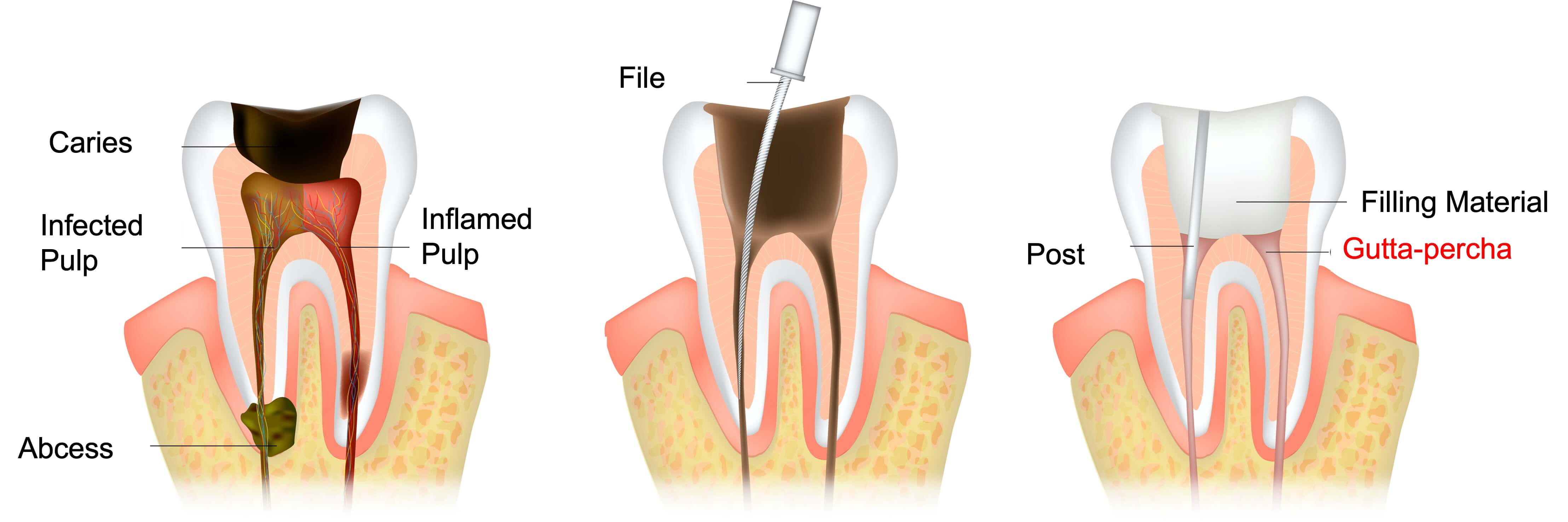 process of obturation with gutta-percha