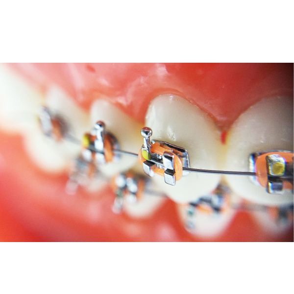 10 Kits De Brackets Dentaires Orthodontiques Mini MBT 0.022 Avec Crochet - En Acier Inoxydable, Neufs Sous Emballage, Marque Bomaoer
