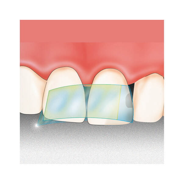 Dispens-O-Mat: Transparent Self-Adhesive Matrices (100 pcs) - 8mm Img: 202508091