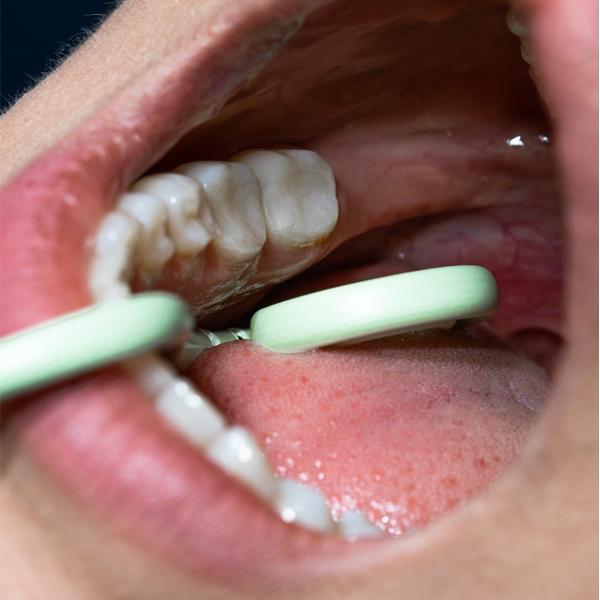 Hygoformic Bio moldable saliva ejector ORSING