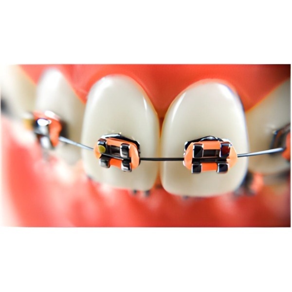 Elastic Orthodontic Ligatures (1042 pcs) VIDU