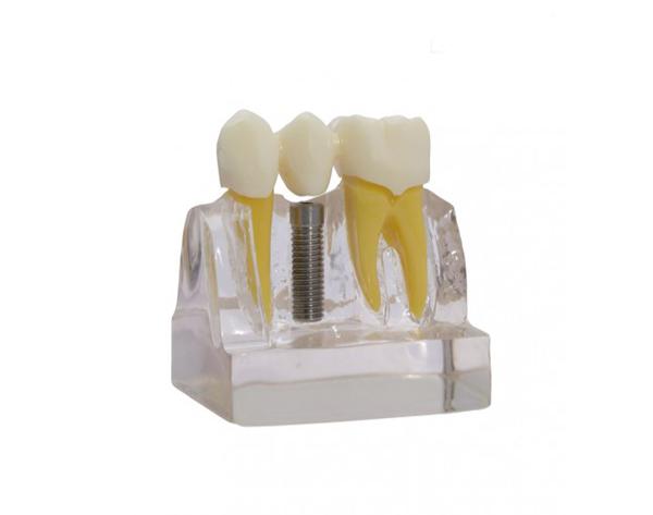 Implant-Bridge demonstration model Img: 202112041