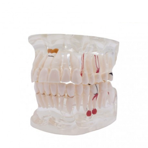 Transparent Typodont - Pathology for Implants Img: 202109111