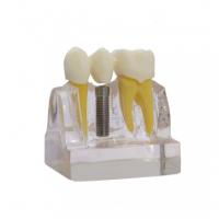 Implant-Bridge demonstration model Img: 202112041