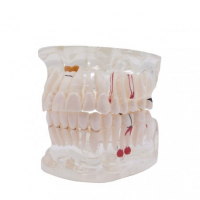 Transparent Typodont - Pathology for Implants Img: 202109111
