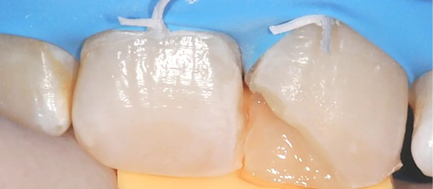 Reconstruction of the composite palatal wall with the aid of a silicone key