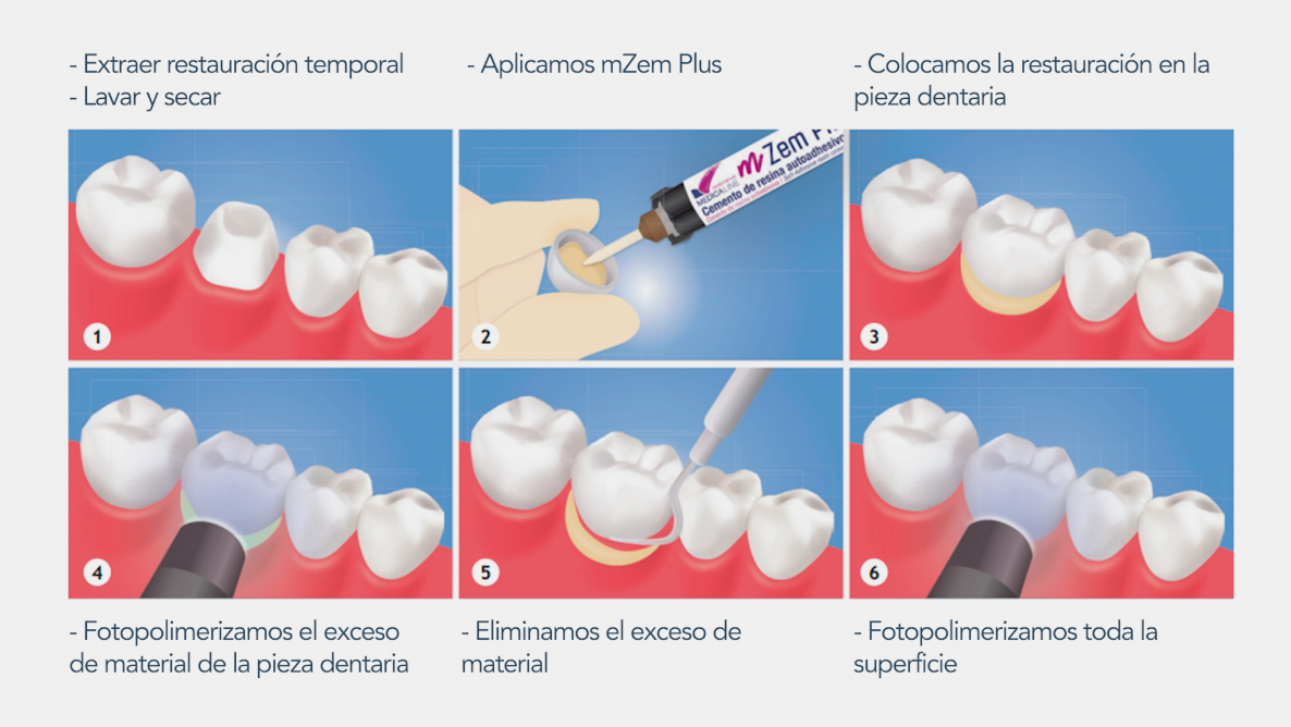 Descubre las cualidades del Cemento de resina Autoadhesivo mZem Plus de Medicaline Dentaltix Descubre las cualidades del Cemento de resina Autoadhesivo mZem Plus de Medicaline Dentaltix