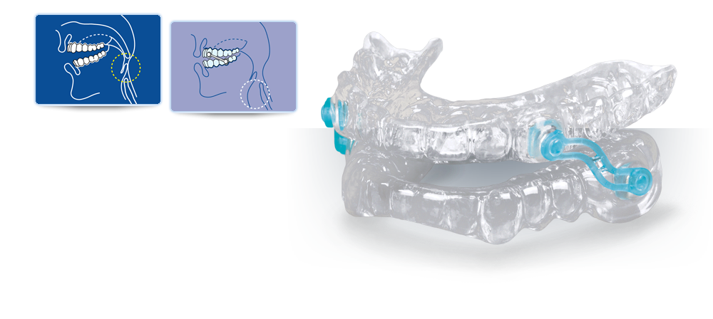 Dispositivo de avance mandibular en niños ▷ Ortodoncia Ourense