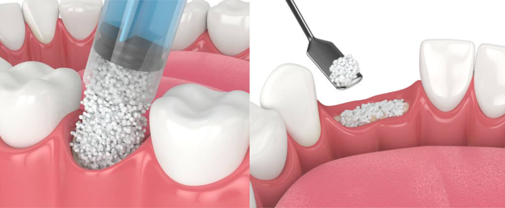 Biomateriales Dentales