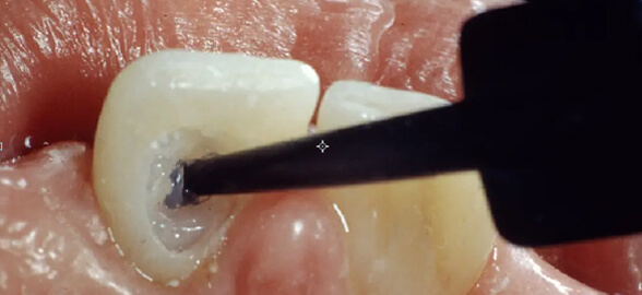 Blanqueamiento dental