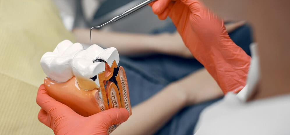 cementos selladores de endodoncia