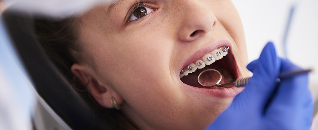 Matériel d'orthodontie