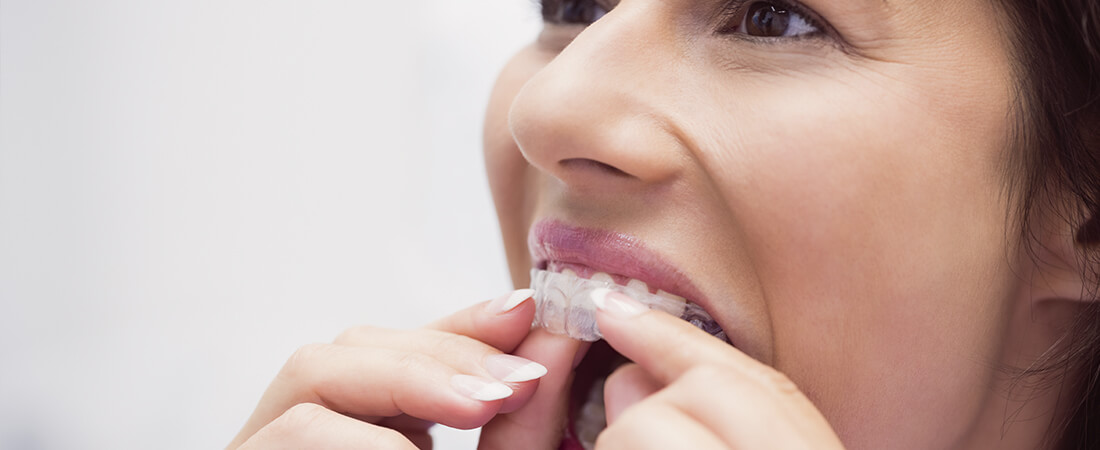 Matériel d'orthodontie