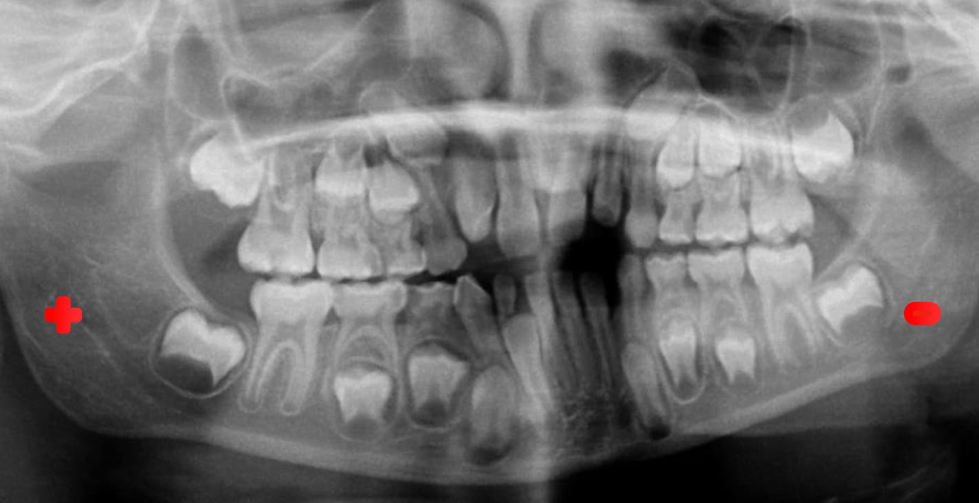 Un lado de la radiografía se ve aumentado y el otro lado reducido en OPG