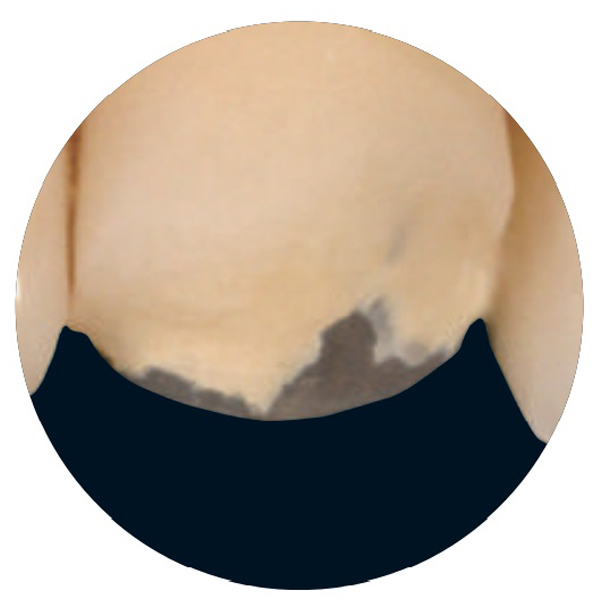 Caso clínico 4: Reparación intraoral de un puente metal-cerámica