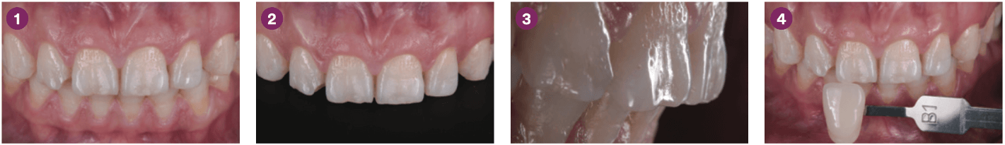 Carillas directas de composite tras el tratamiento de ortodoncia