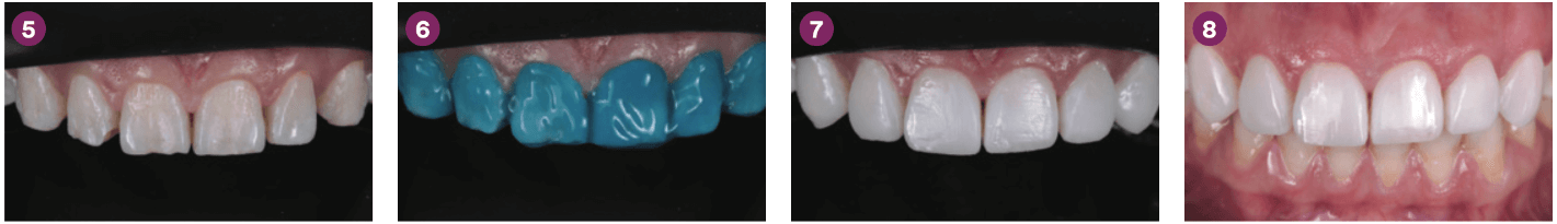 Carillas directas de composite tras el tratamiento de ortodoncia
