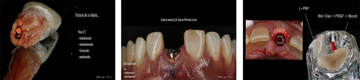 Caso clínico implante dental parte 2