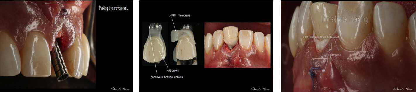 Cas clinique implant dentaire partie 3