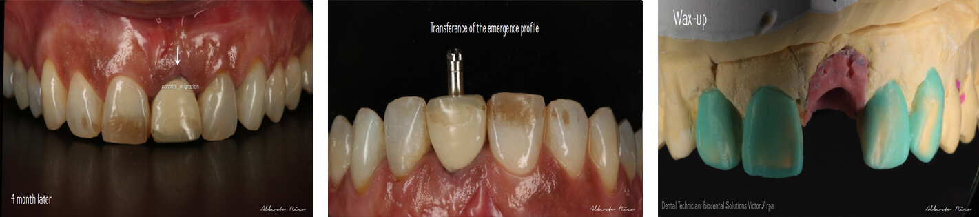 Cas clinique implant dentaire partie 4