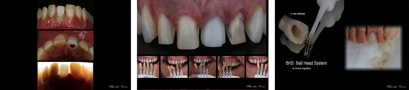 Cas clinique implant dentaire partie 5