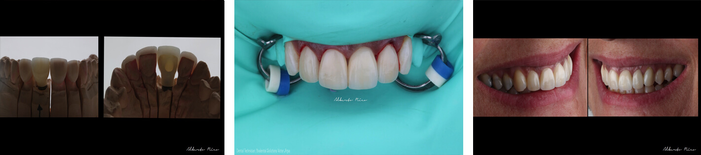 Cas clinique implant dentaire partie 6