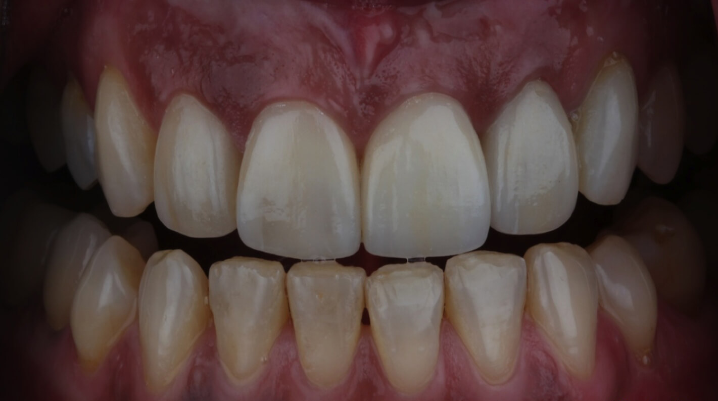 Partes que forman un implante dental