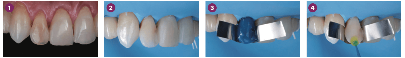 Tratamiento restaurador no invasivo de incisivo lateral decolorado