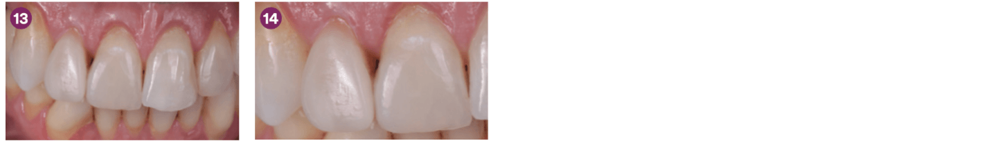 Tratamiento restaurador no invasivo de incisivo lateral decolorado