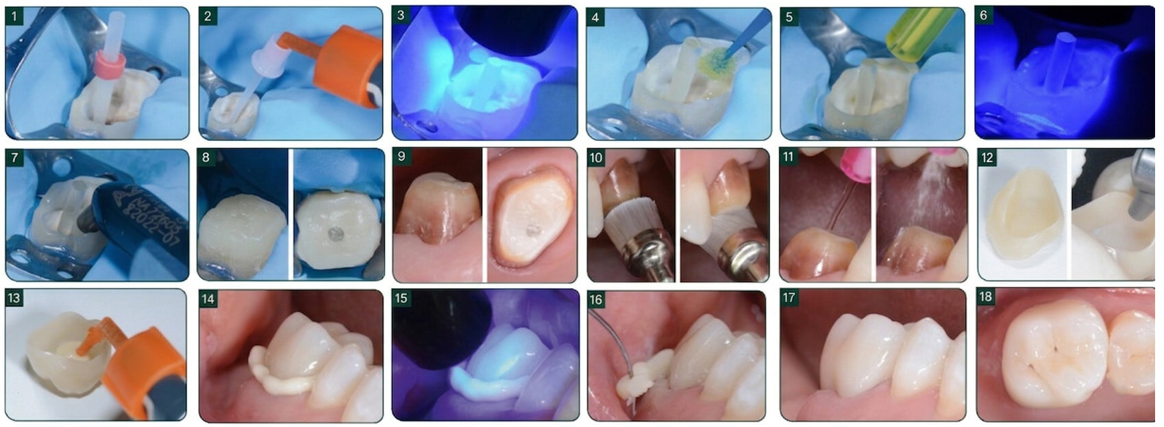 ccas clinique scellement adhésif