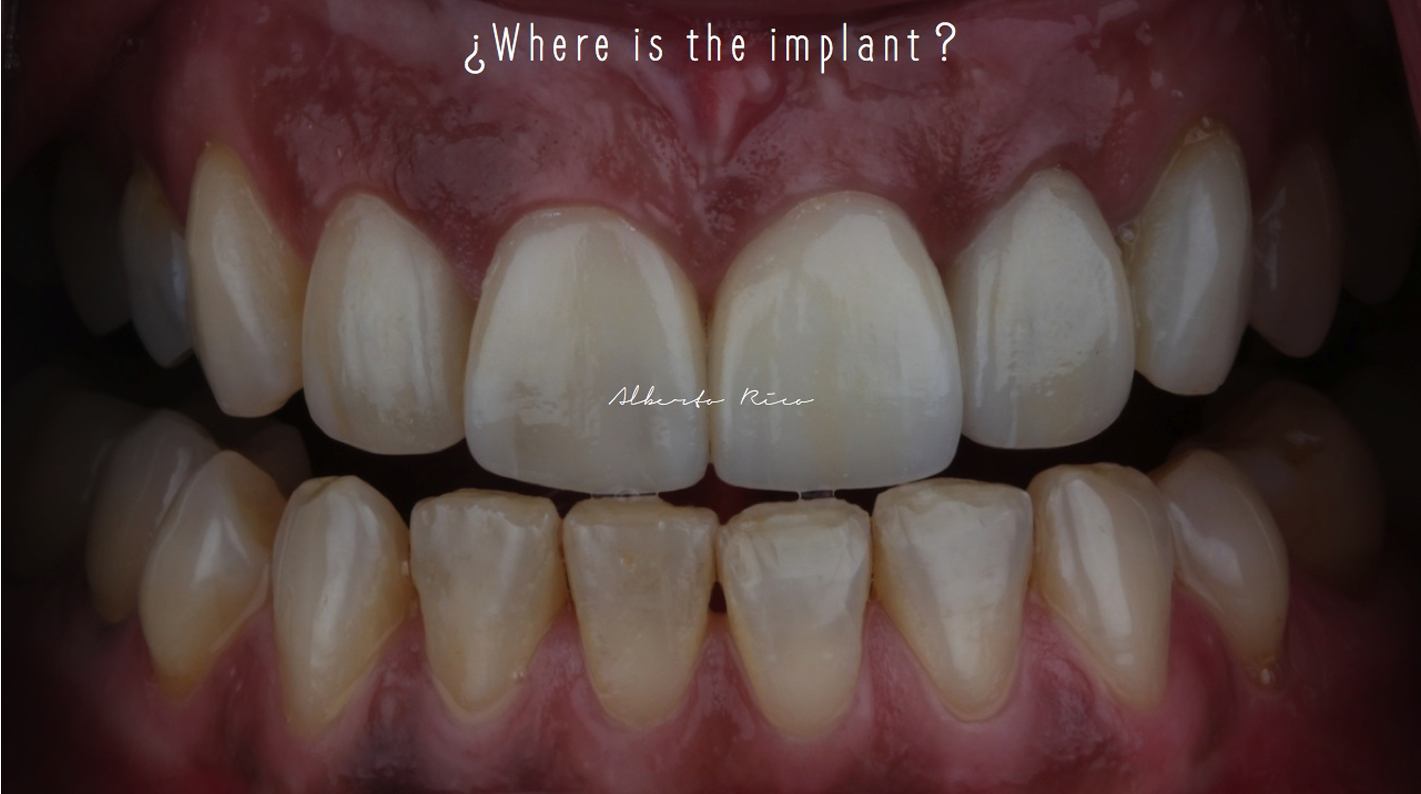 Cas clinique implant dentaire partie 1