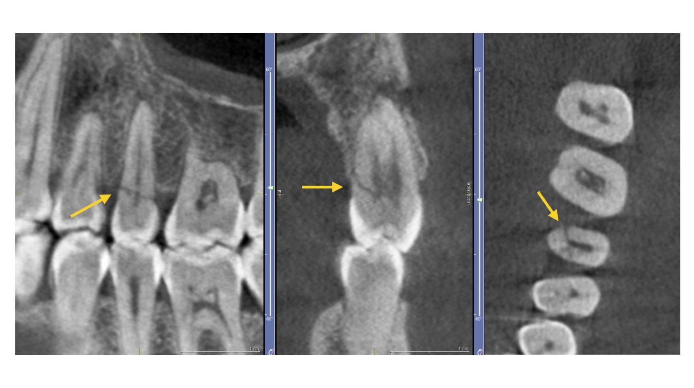 Aplicación del CBCT en Endodoncia