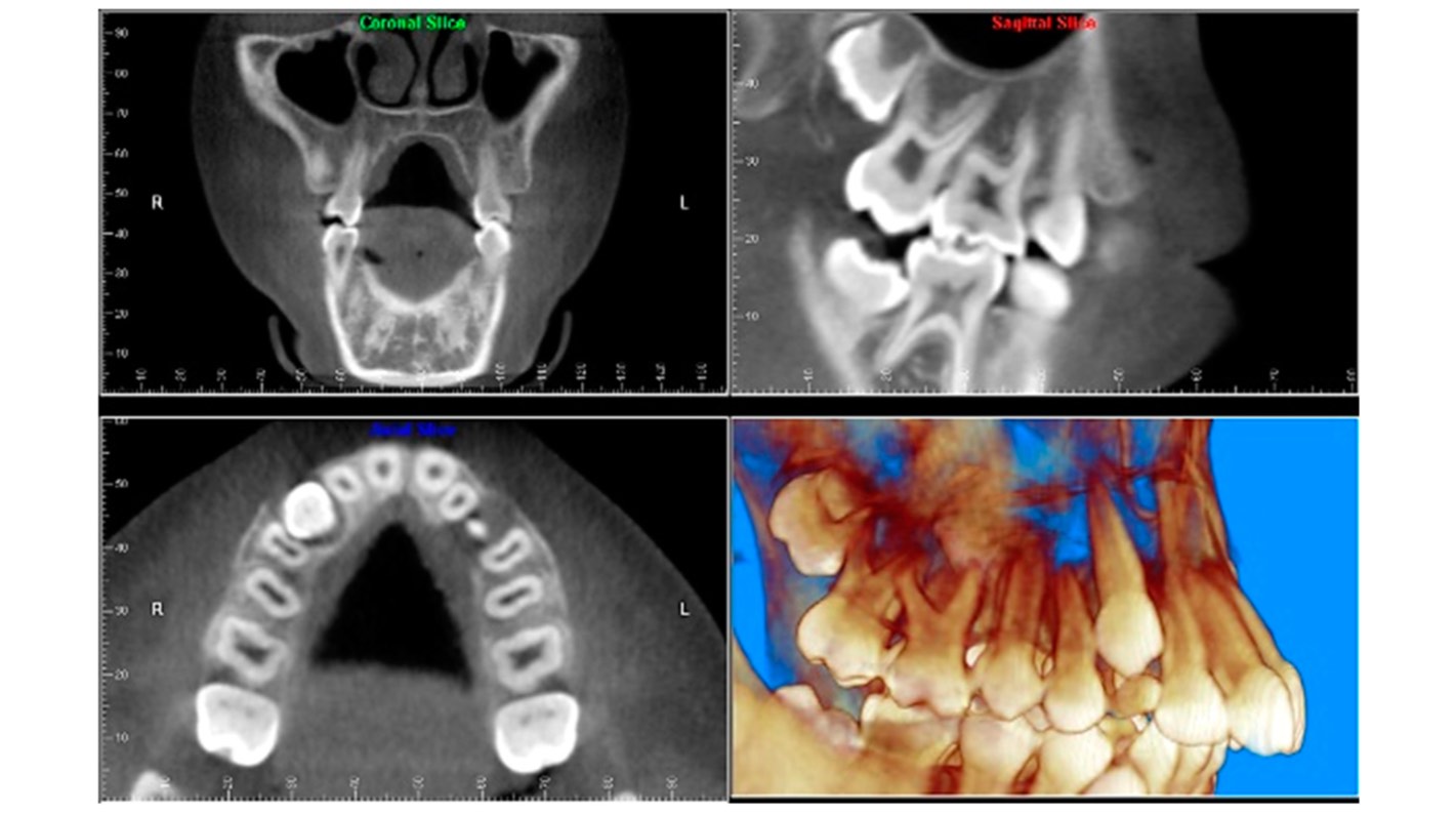 Aplicación del CBCT en Ortodoncia