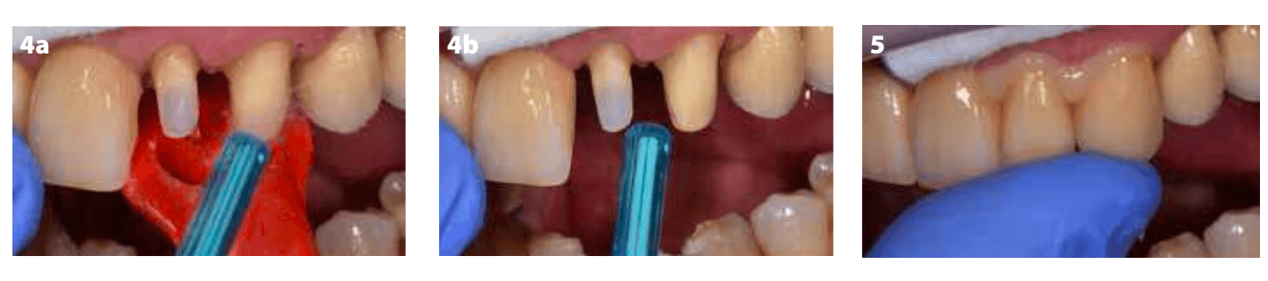 Cementation de couronnes en zirconium avec G Cem One