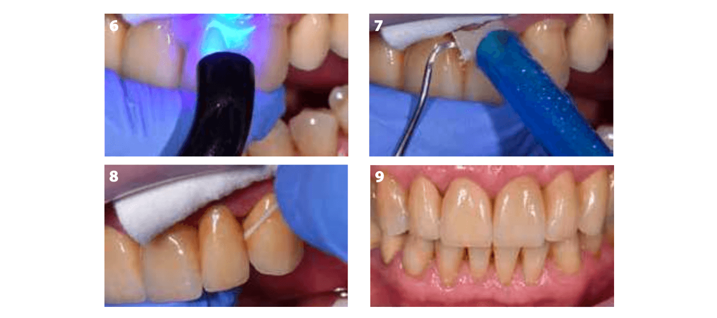 Cimentation de couronnes en zirconium avec G Cem One