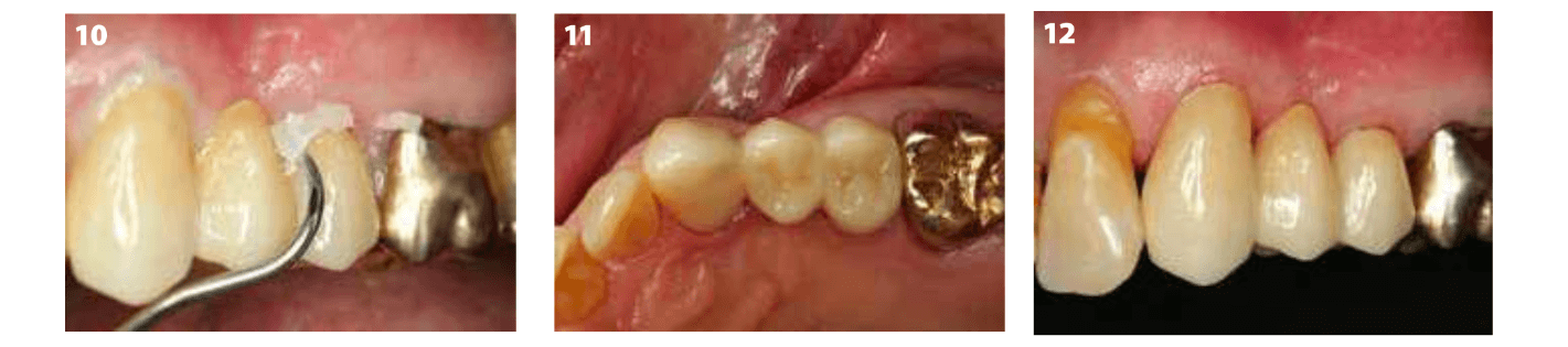  Cimentation de pont monolithique en oxyde de zirconium avec G Cem One 