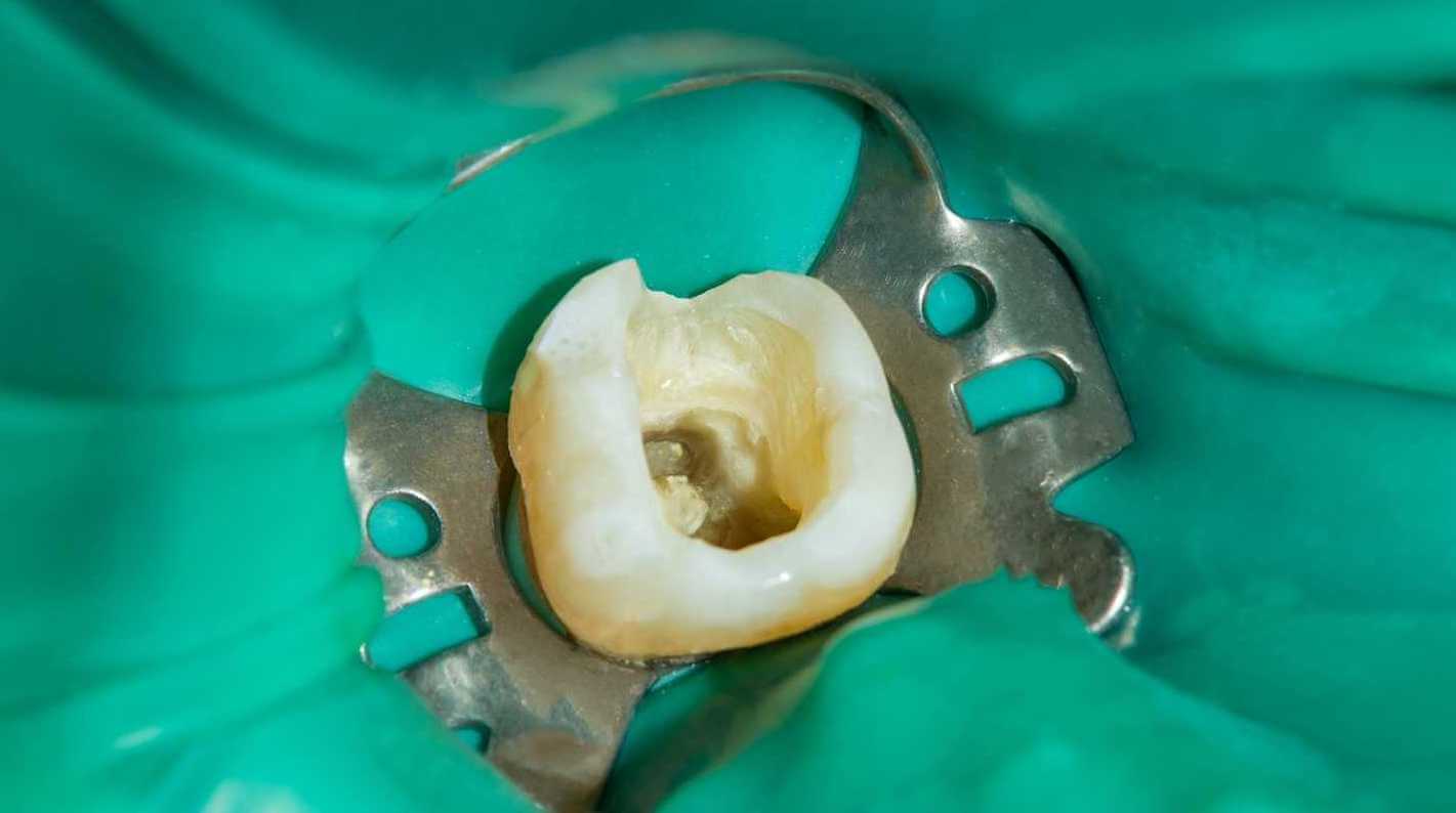 Les digues en caoutchouc en isolement dentaire : Caractéristiques et  utilisations ! - Distributeur de máteriel dentaire - Dentaltix