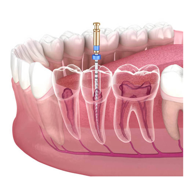 curso de endodoncia con limas platinum