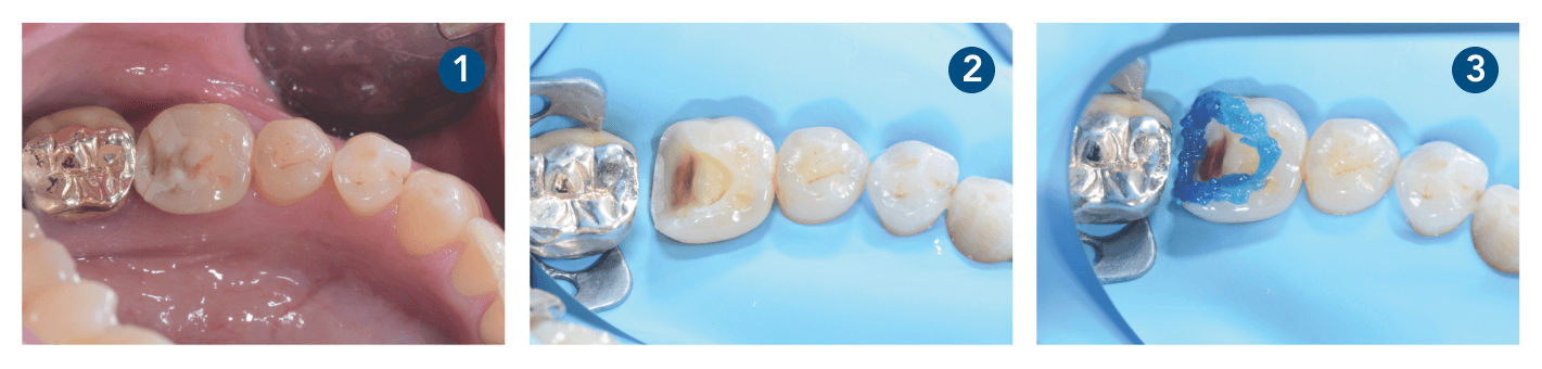 Caso clínico 3M Filtek One Bulk Fill Restorative